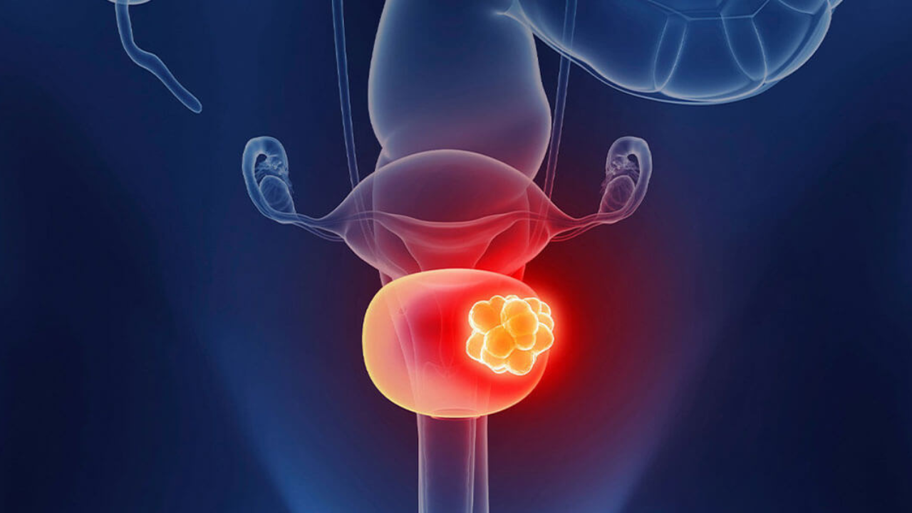 The Latest Advances in Bladder Cancer Research and Therapy