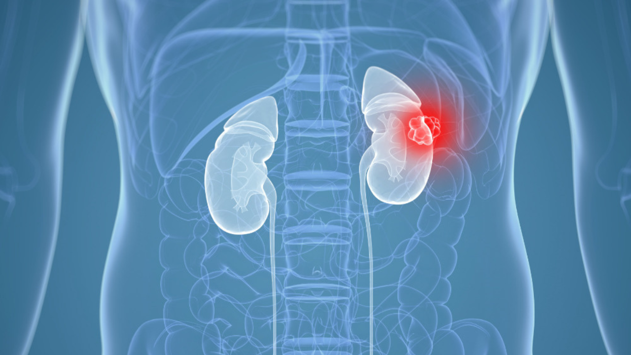 Understanding the Impact of Kidney Cancer  on  Yours  Health